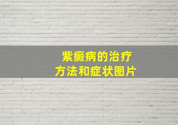 紫癜病的治疗方法和症状图片